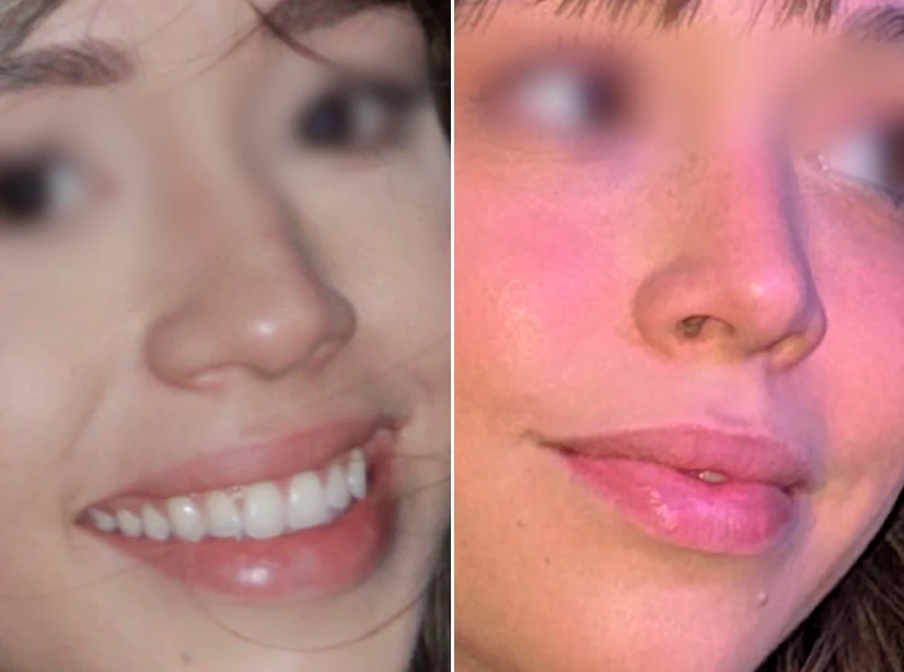 antes e depois do procedimento cirúrgico