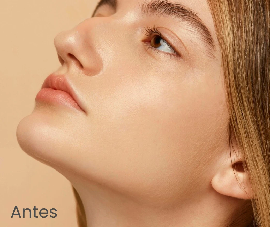 antes-rinoplastia